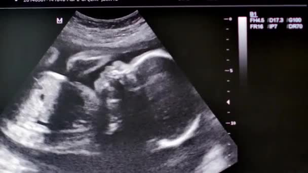 Monitor met medische echografie van menselijke baby. 4 k Ultrahd video — Stockvideo