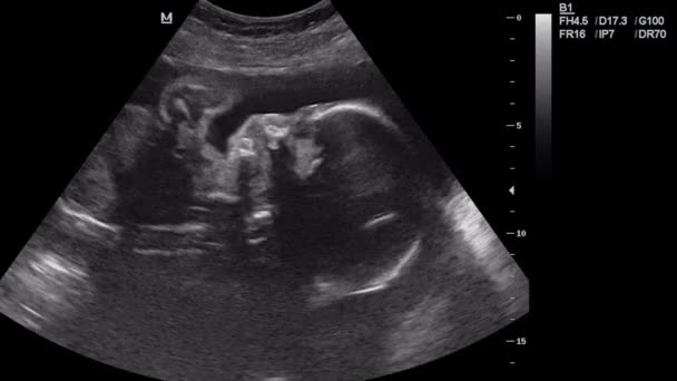 6 ay içinde hamile bir kadının ultrasonu. — Stok video