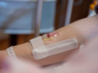 Hasta koluna yerleştirilmiş bir kanülü kapat.