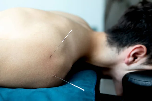 Young man in an acupuncture therapy
