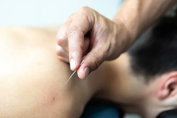 Junger Mann in einer Akupunkturtherapie — Stockfoto
