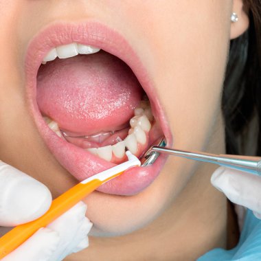 İnsan dişleri Temizleme interdental