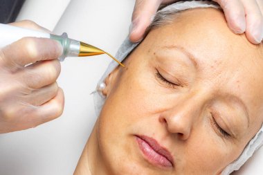 Macro close up detail of laser plasma pen removing facial wart on middle aged woman. clipart