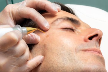 Close up detail of laser plasma pen removing facial moles on middle aged man. clipart