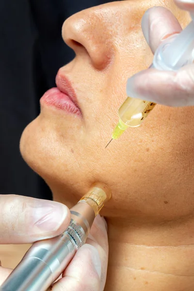 Macro Close Detail Therapist Injecting Enzymes Derma Pen Senior Woman — Stock Photo, Image