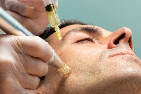 Macro Close Terapeuta Injetando Enzimas Bochecha Com Caneta Derma Homem — Fotografia de Stock