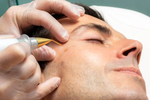 Detalhe Perto Caneta Plasma Laser Removendo Moles Faciais Homem Meia — Fotografia de Stock