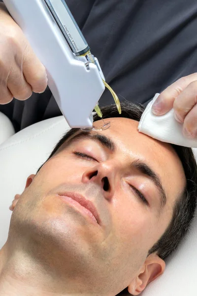 Makro Närbild Medelålders Man Med Kosmetisk Ansiktslyft Plasma Pannan Med — Stockfoto