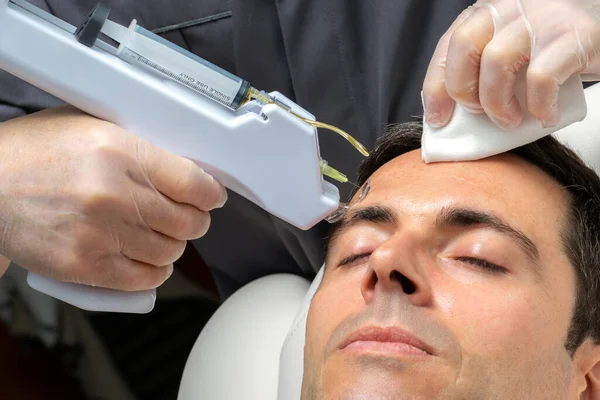 Makro Närbild Medelålders Man Med Kosmetisk Ansiktslyft Plasma Pannan Med — Stockfoto