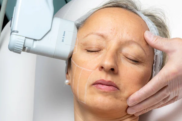 Top View Woman Having Cosmetic Facial High Intensity Focal Ultrasound — Stock Photo, Image