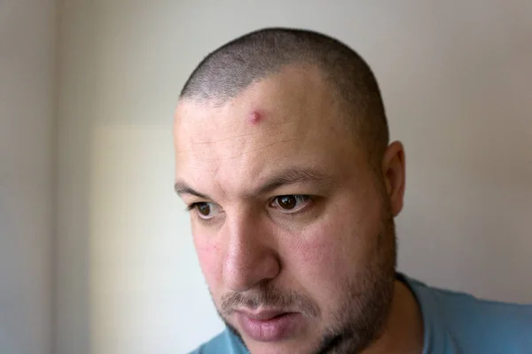 sivilce veya akne abcess portre