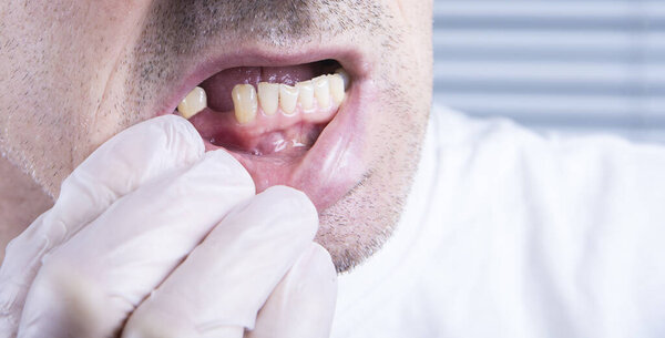 Closeup teeth, dental health care clinic with missing tooth