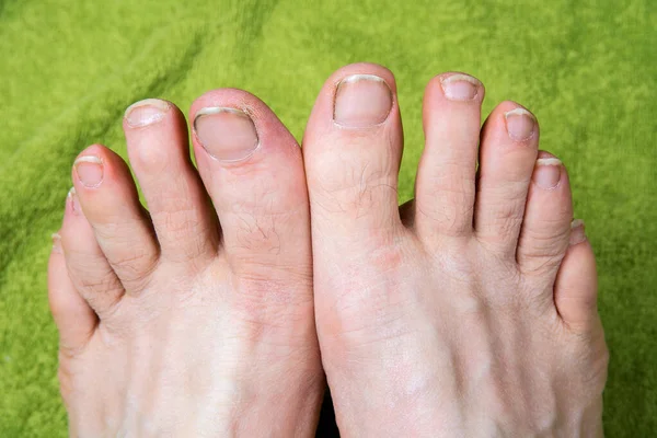 Грязные Ногти Ногах Человека Зеленом Полотенце — стоковое фото