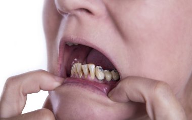 Kötü dişli ve tartarlı bir kadın sigaradan ve eski taçlardan