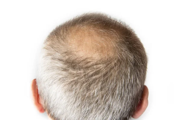 Łysy Facet Grzebieniem Koncepcja Wypadania Włosów — Zdjęcie stockowe