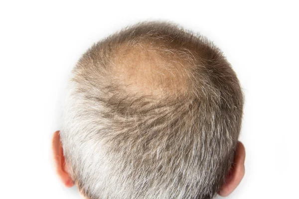 Hombre Calvo Con Peine Concepto Pérdida Cabello — Foto de Stock