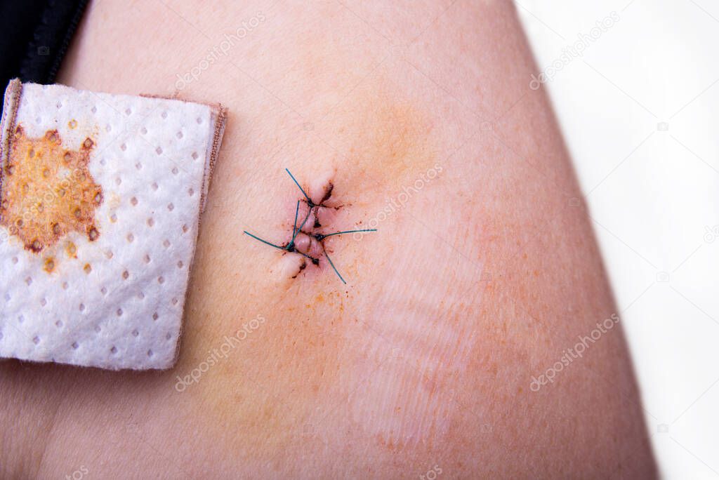 Three stitches on a woman arm after surgery