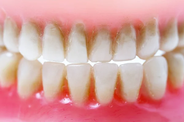 Schmutzige Zahnplatte — Stockfoto