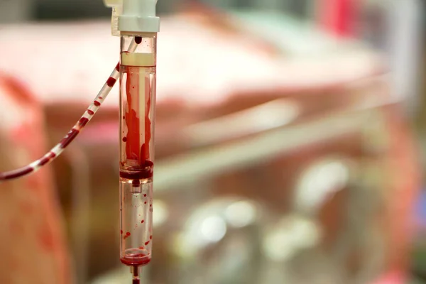 Nahaufnahme Blut Röhre Übertragung Ein Krankes Neugeborenes Auf Verschwommenem Babyinkubator — Stockfoto