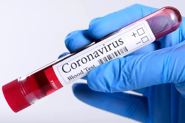 Covid Test Laboratory Sample Blood Testing Diagnosis Coronavirus Infection Hands — Stock Photo, Image