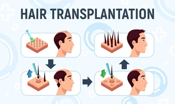 Ilustración vectorial de un procedimiento de trasplante de cabello — Vector de stock