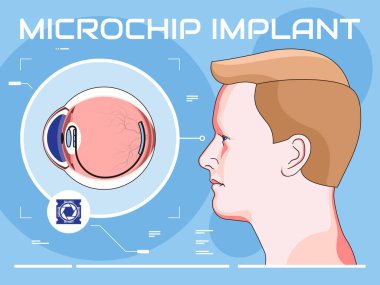 Modern mikro göz implantasyonunun vektör çizimi
