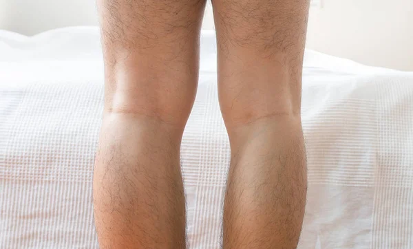 Asian man leg bandy-legged shape of the bow legs,Close up