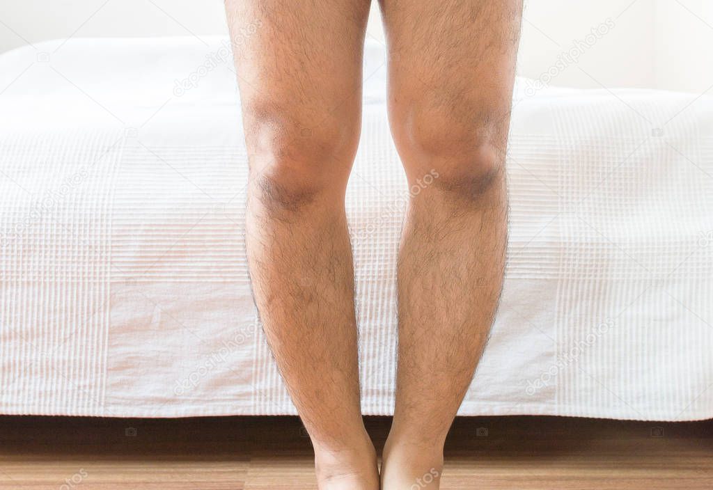 Asian man leg bandy-legged shape of the legs,Close up