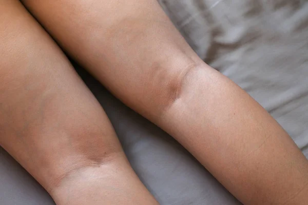 Varicose Veins Womans Legs — Stock Photo, Image