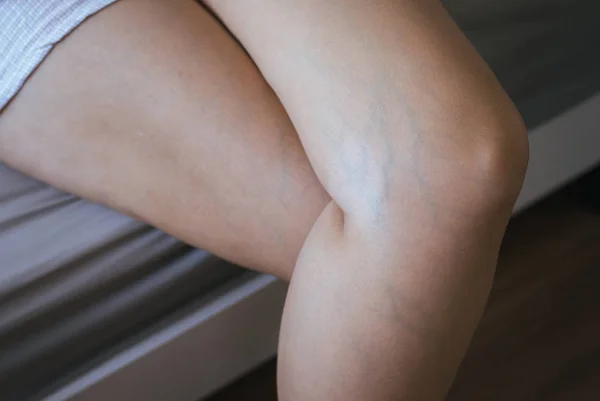 Varicose Veins Womans Leg — Stock Photo, Image