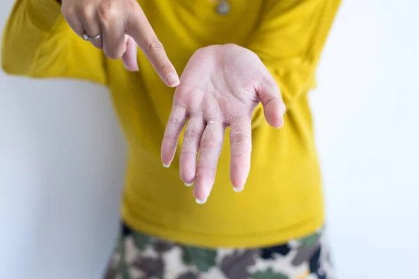 Woman Hand Removes Flaky Skin Health Care Skin Concept Close — Stock Photo, Image