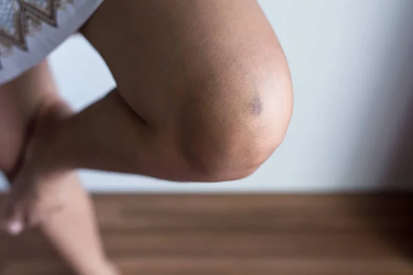 Blaue Flecken Auf Der Haut Der Frau Gesundes Hautpflegekonzept — Stockfoto