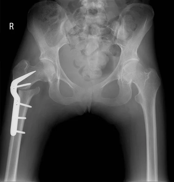 Radiografia da pelve com fratura do pescoço da coxa. Com fixação subsequente de metal — Fotografia de Stock
