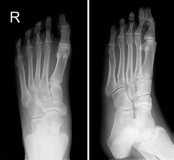 Рентгенівське зображення правої ноги показує перелом п'ятого пальця — стокове фото