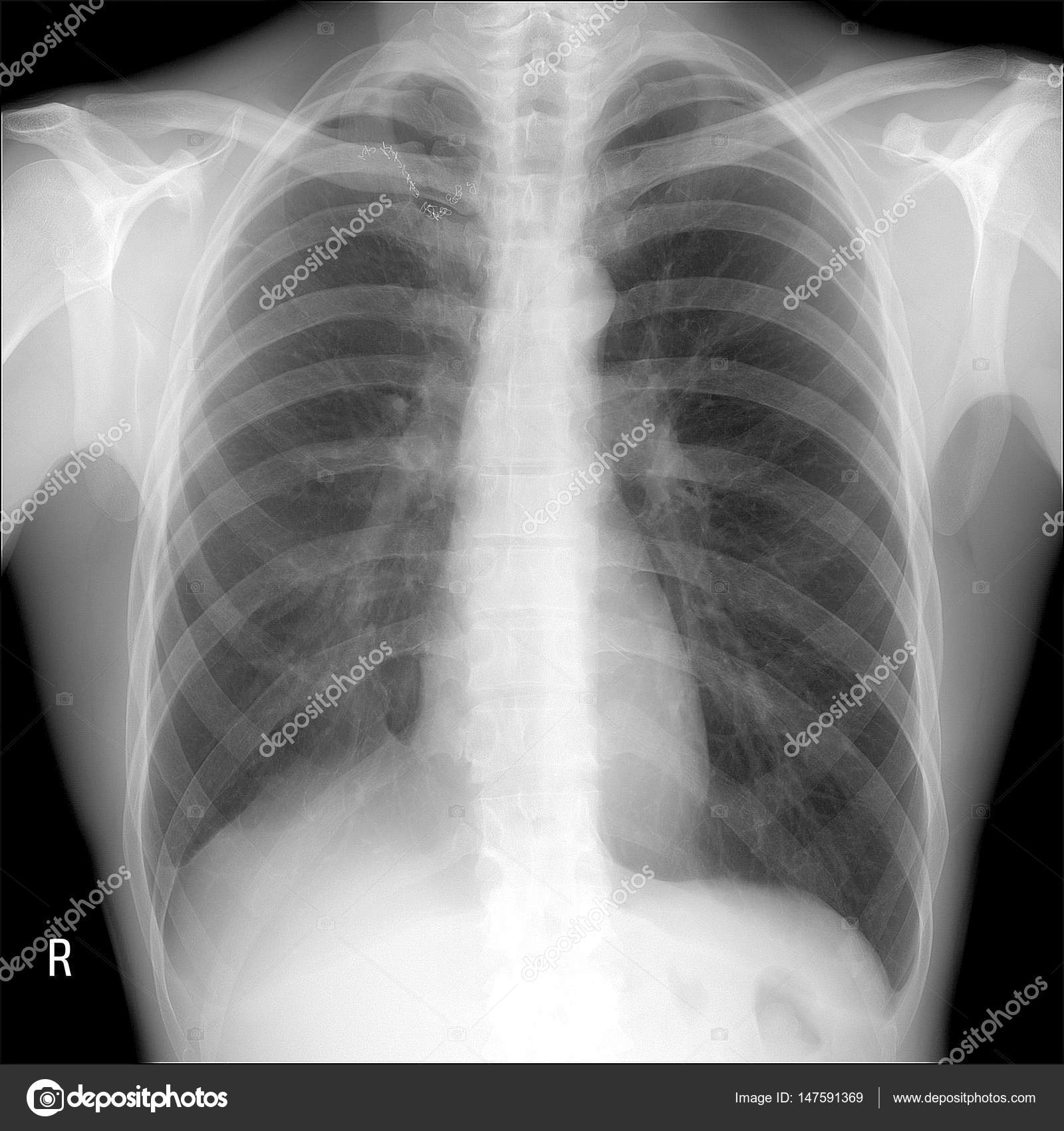 Grátis: TUBERCULOSE, ATELECTASIA NO RAIO-X - Material Claro e Objetivo em  PDF para Estudo Rápido, image size:1600x1700