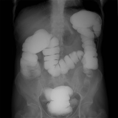 X-ray of the lower parts of the gastrointestinal tract (GI). Tight filling. Chronic colitis.  clipart