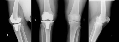 x-ray view knees. Right - Total knee replacement show metallic joint implant in bone and left knee - Osteoarthritis. clipart