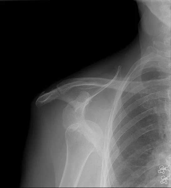 X-Ray görüntü omuz, gösterir şu omuz çıkığı. Ön projeksiyon