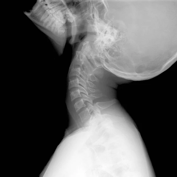 Raios-X do pescoço e da coluna cervical teste de função lateral (LAT) Extensão máxima - Instabilidade — Fotografia de Stock