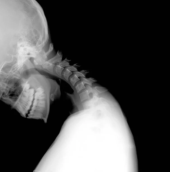 X 射线的脖子和颈椎功能测试外侧 (Lat) 最大弯曲-不稳定 — 图库照片