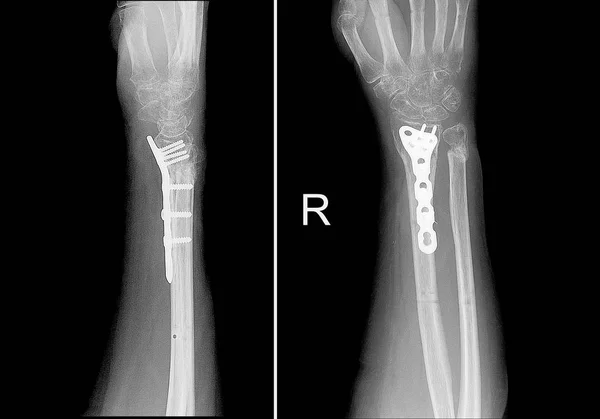 X-ray kép a jobb oldali a törés a sugár-, a fém szerkezet utólagos rögzítés — Stock Fotó