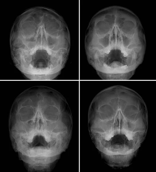 X 射线胶片为正面人脸，鼻子-下巴投影。很多人的图像。鼻窦炎。规范. — 图库照片