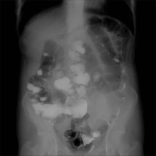 Gastrointestinal sistem (GI) alt kısımlarında X-Ray. Hava üfleme. Kronik kolit. 