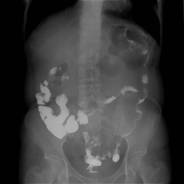Рентген нижньої частини шлунково-кишкового тракту (ГГ). Спорожнити. Хронічний коліт . — стокове фото