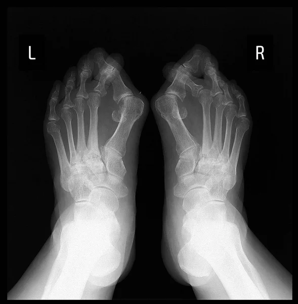 Röntgen láb. Hallux valgus. — Stock Fotó