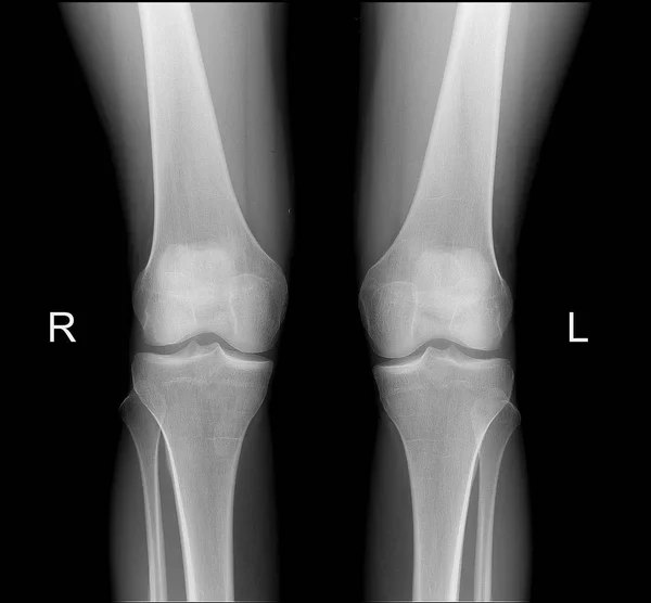 Рентген коленных суставов в нормальной фронтальной проекции — стоковое фото