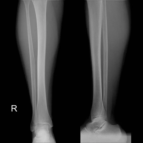 Рентгеновское изображение голени, вид спереди в норме . — стоковое фото