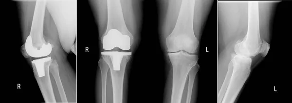 x-ışını görünümü diz. Doğru - Total diz değiştirme göstermek metalik ortak implant kemik ve sol diz - osteoartrit.