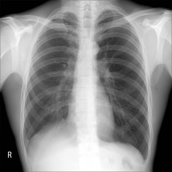 Röntgen-Lungen: Lobektomie rechte Lunge nach Tuberkulose — Stockfoto