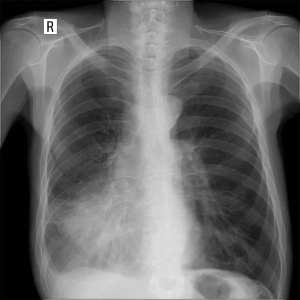 Rentgenové plic. Zobrazeno velké infiltráty v středního laloku pravé plíce. Zápal plic. — Stock fotografie